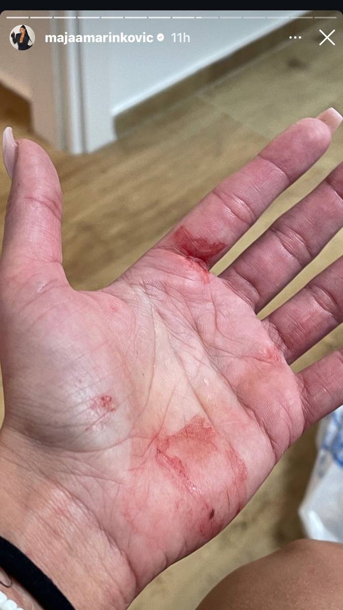 Pretučena Maja Marinković! Sva krvava i u modricama, za nasilje optužila Filipa Cara: Gurao mi je pištolj u usta 😲(UZNEMIRUJUĆE FOTOGRAFIJE)